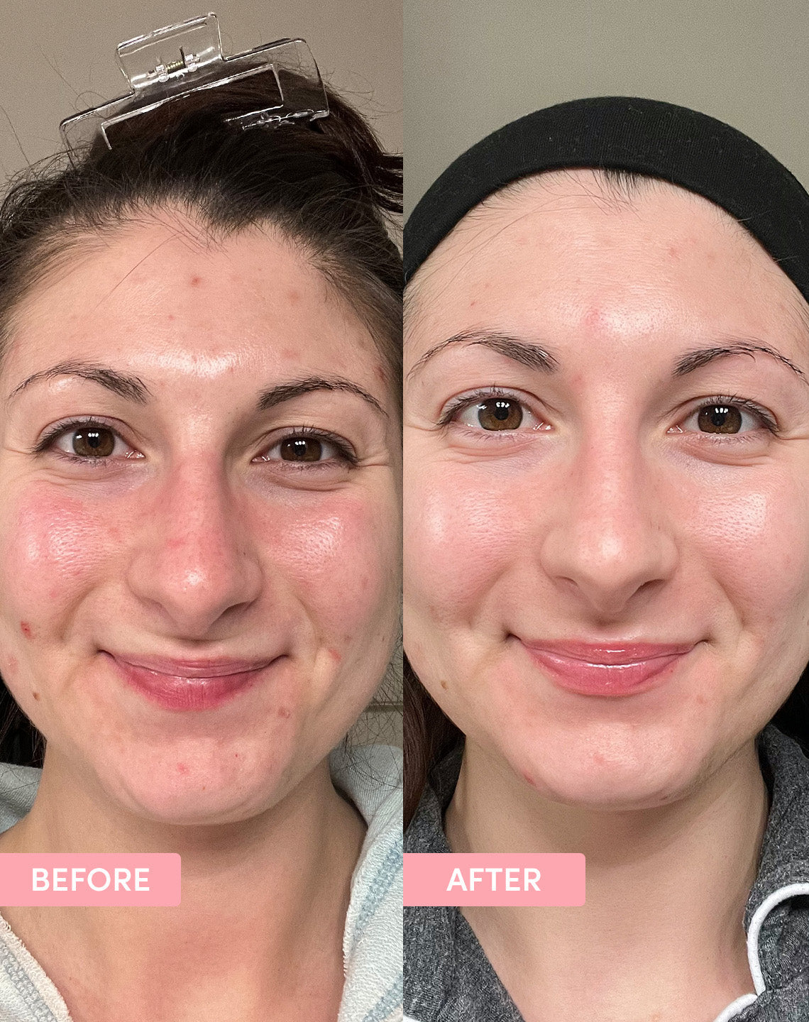 Pore Minimising Kit - before and after results