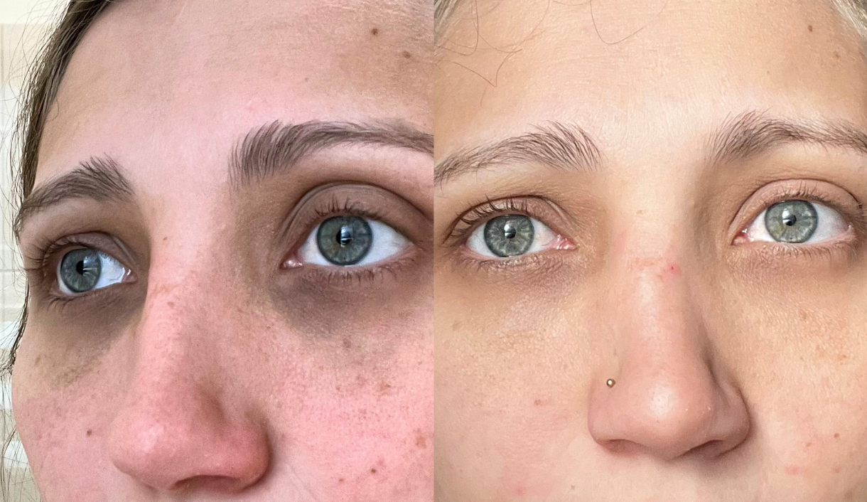 Causes of Eyebags and How To Deal With Tired Eyes