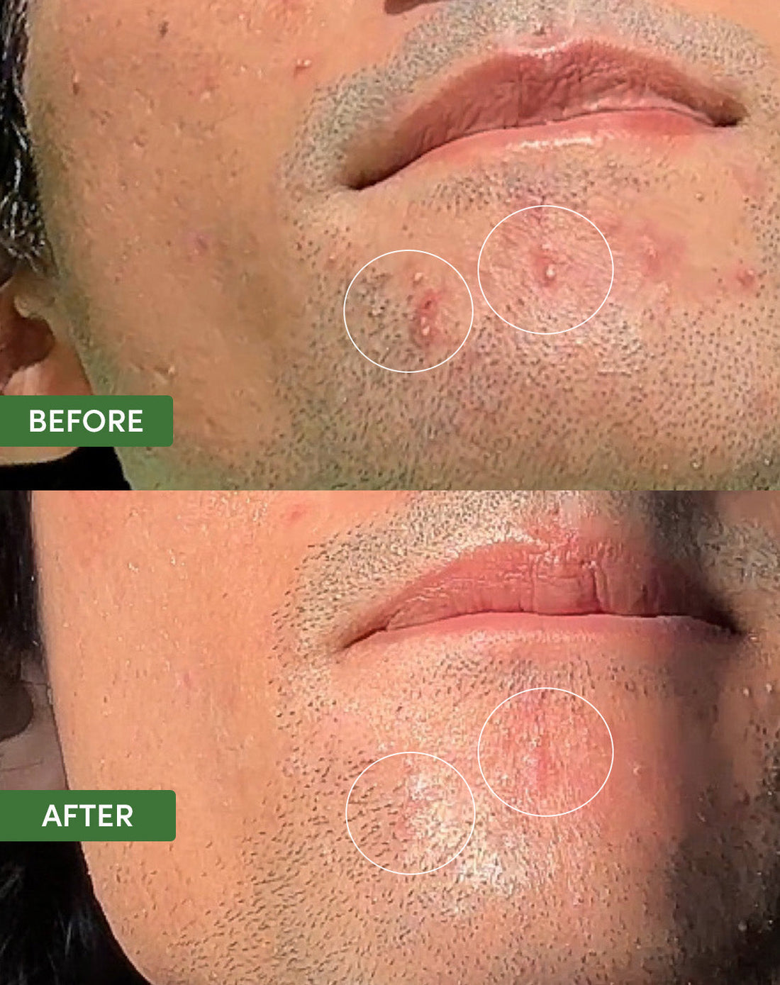 Oil Control Dual Action Blemish Patches - product angle view