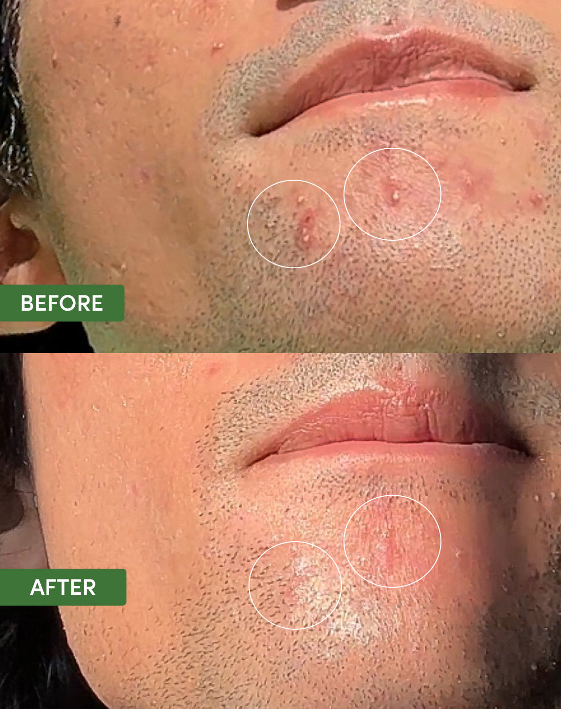 Oil Control Dual Action Blemish Patches - product angle view