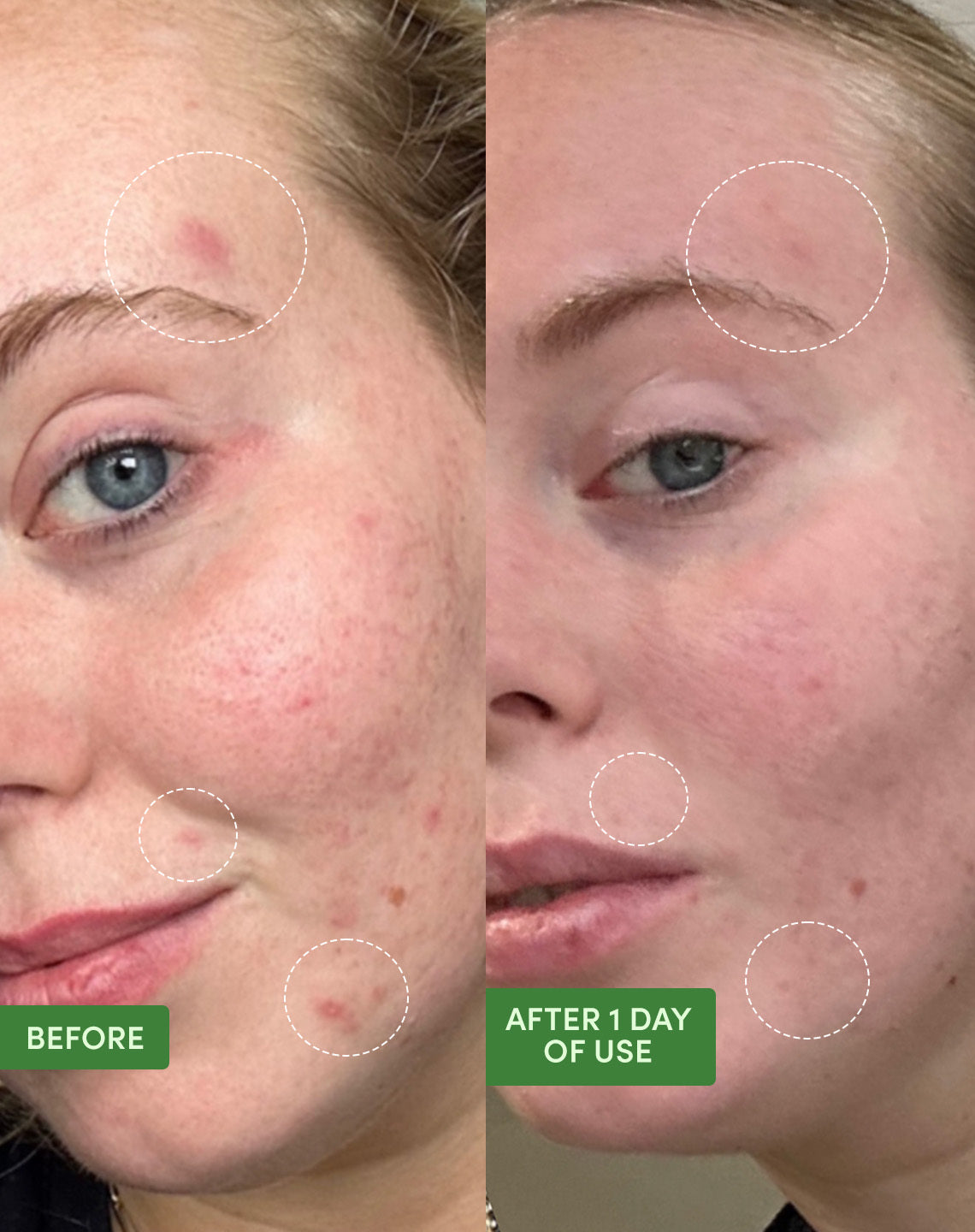 SandSky Pimple Patrol Kit – Produktfoto des Sets