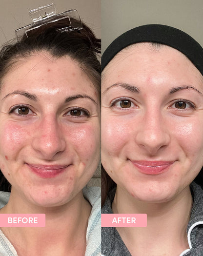Pore Minimising Kit - before and after results